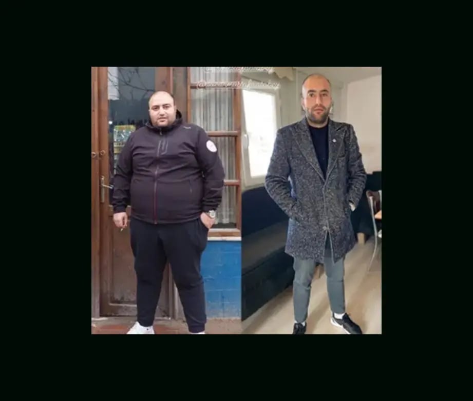 mustafa-atabey-md-gastric-sleeve-before-after-10