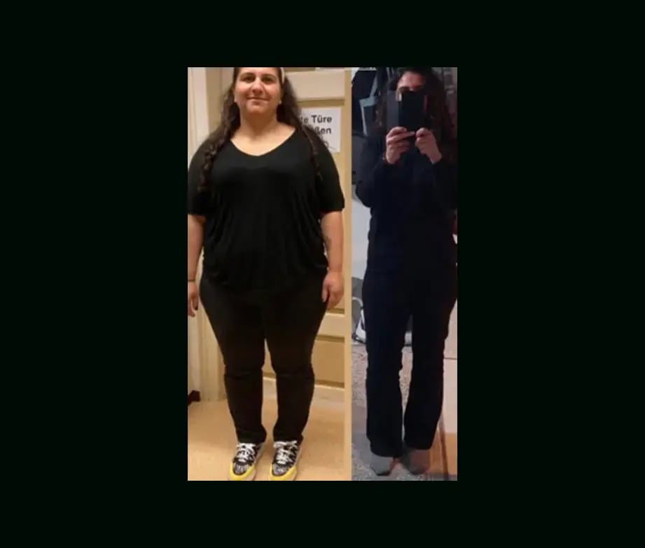 mustafa-atabey-md-gastric-sleeve-before-after-12