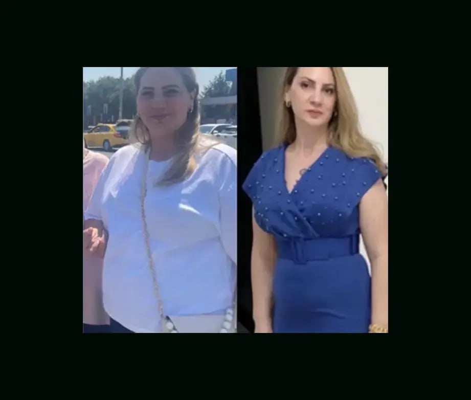 mustafa-atabey-md-gastric-sleeve-before-after-14