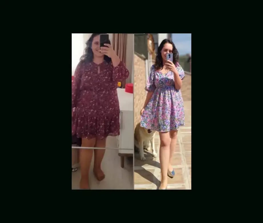 mustafa-atabey-md-gastric-sleeve-before-after-16