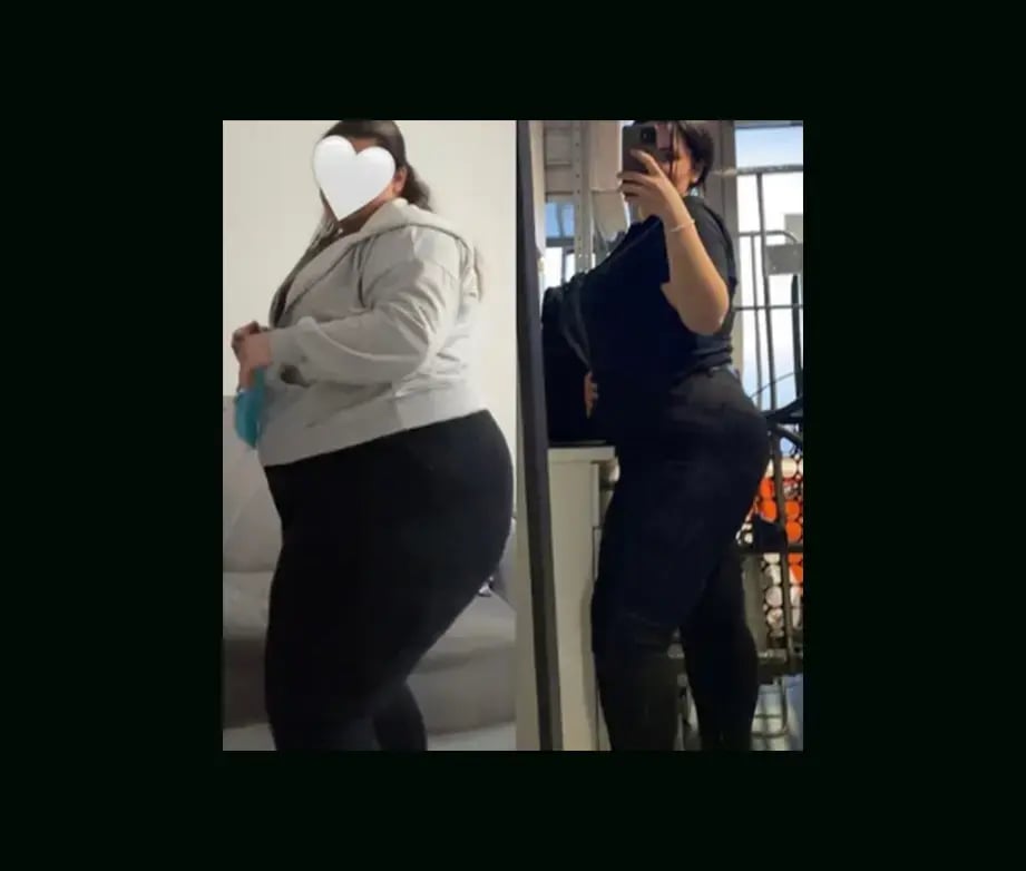 mustafa-atabey-md-gastric-sleeve-before-after-17