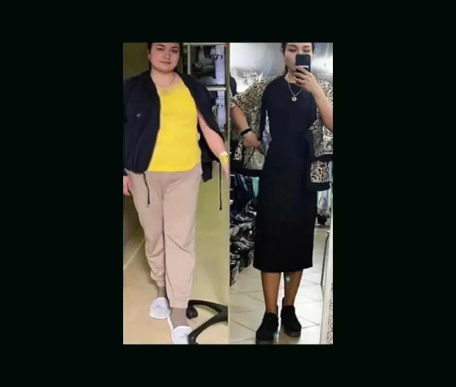 mustafa-atabey-md-gastric-sleeve-before-after-18