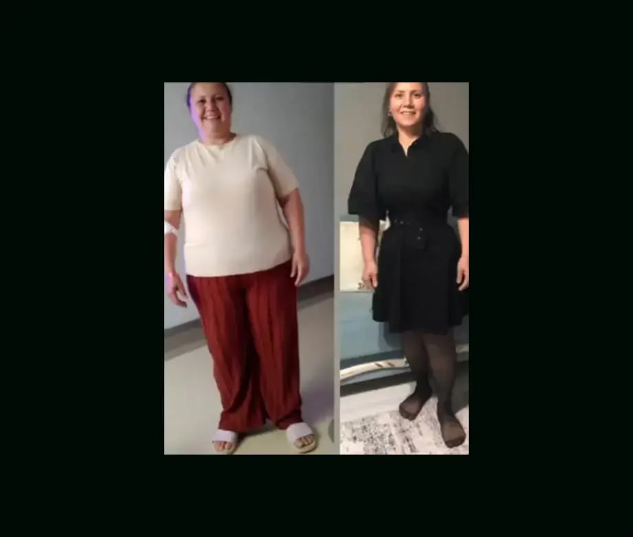mustafa-atabey-md-gastric-sleeve-before-after-19