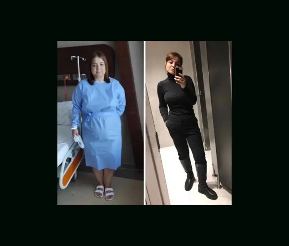 mustafa-atabey-md-gastric-sleeve-before-after-21