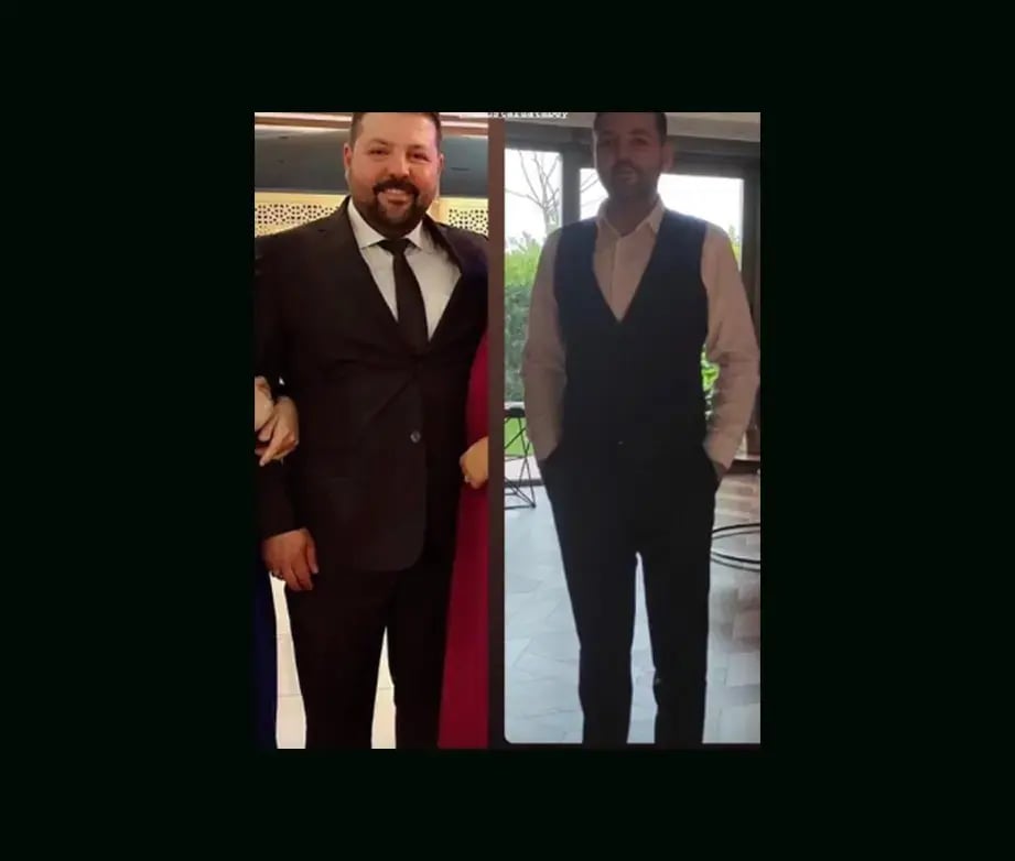mustafa-atabey-md-gastric-sleeve-before-after-22