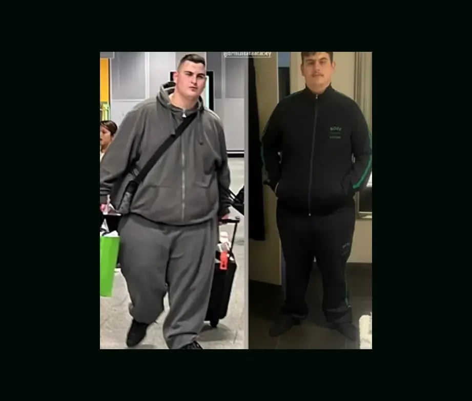 mustafa-atabey-md-gastric-sleeve-before-after-23