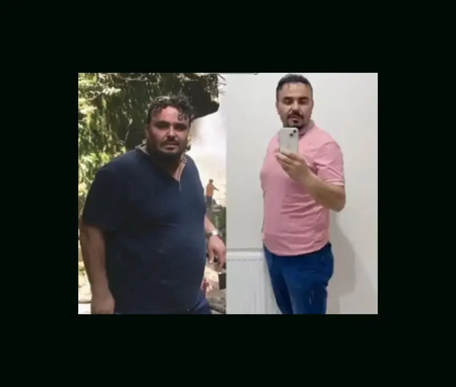 mustafa-atabey-md-gastric-sleeve-before-after-24