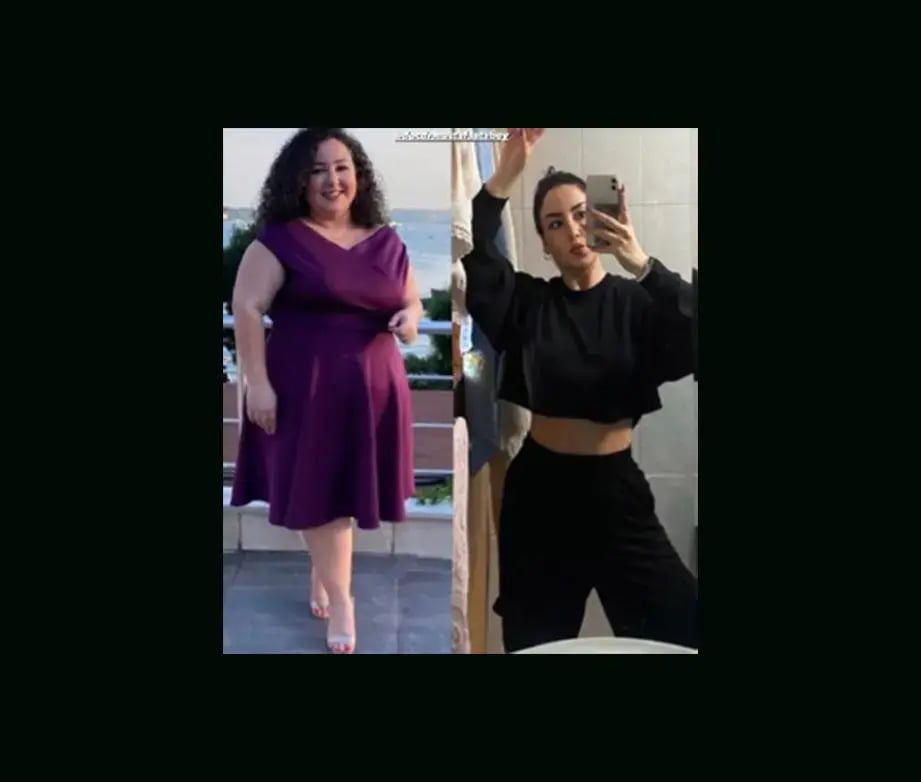 mustafa-atabey-md-gastric-sleeve-before-after-25