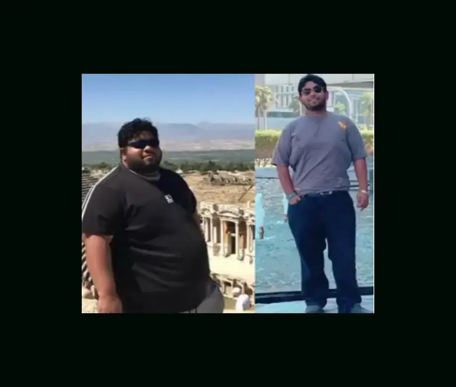 mustafa-atabey-md-gastric-sleeve-before-after-27