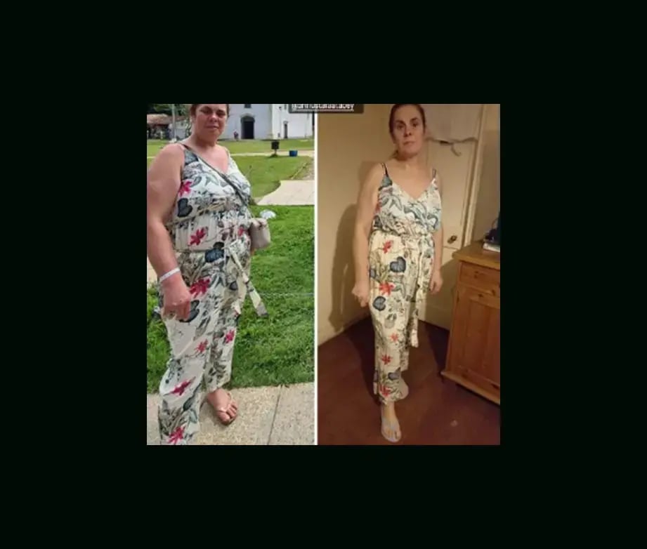 mustafa-atabey-md-gastric-sleeve-before-after-3