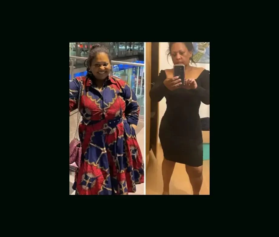 mustafa-atabey-md-gastric-sleeve-before-after-32