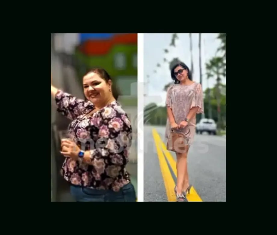 mustafa-atabey-md-gastric-sleeve-before-after-33