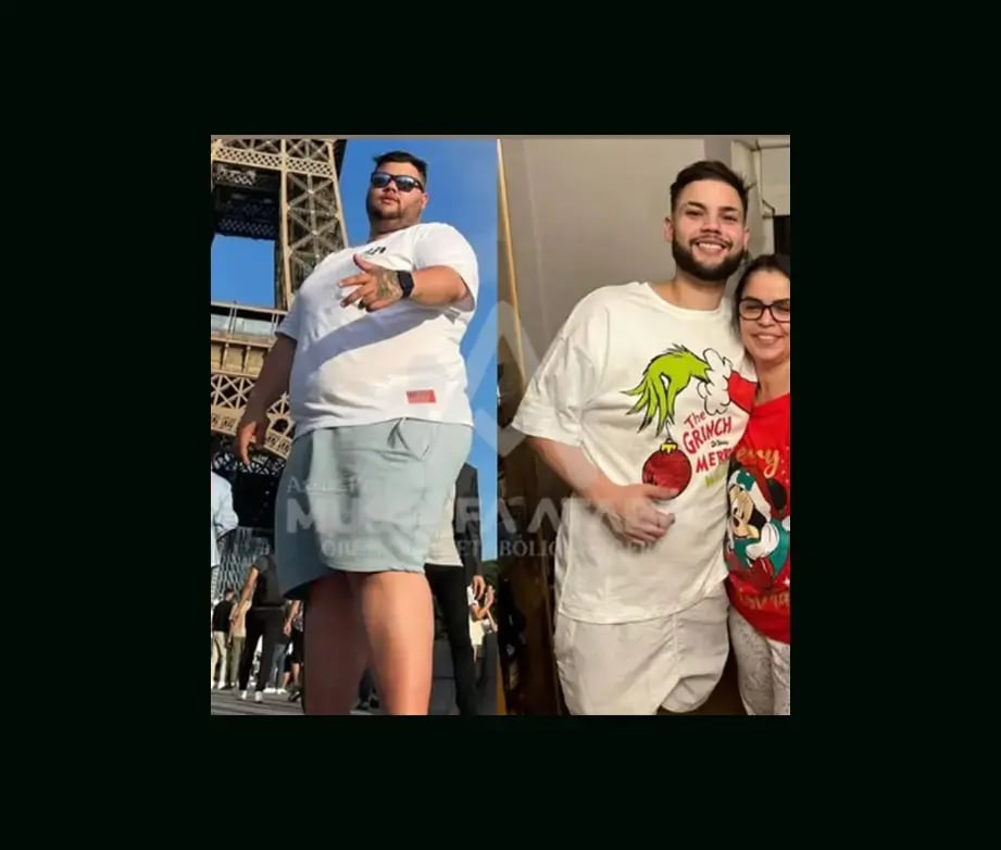 mustafa-atabey-md-gastric-sleeve-before-after-34