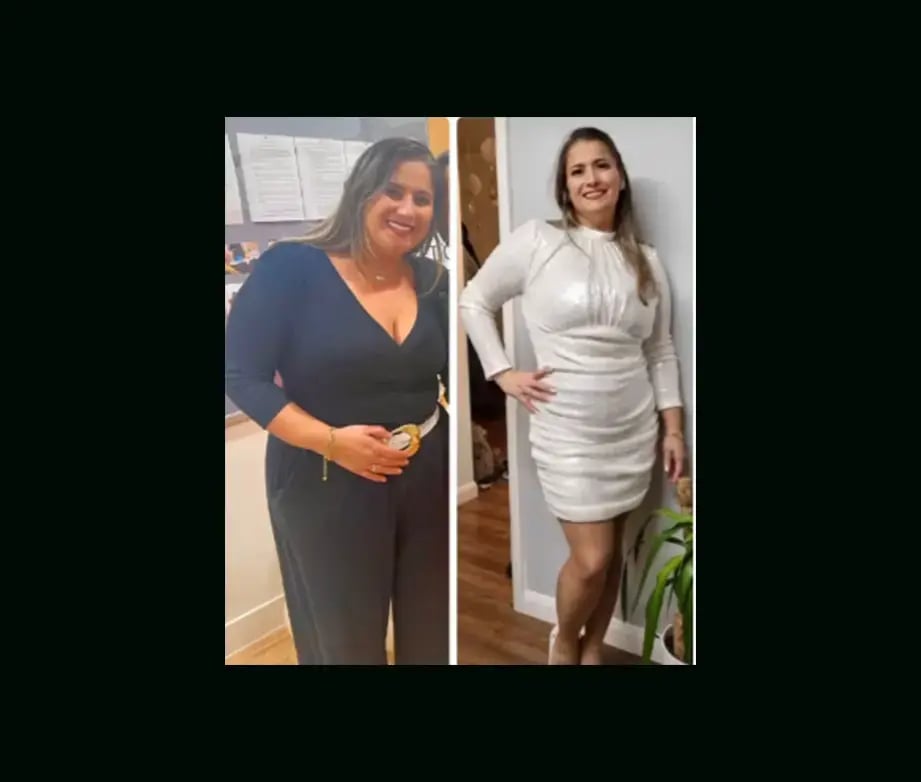 mustafa-atabey-md-gastric-sleeve-before-after-36