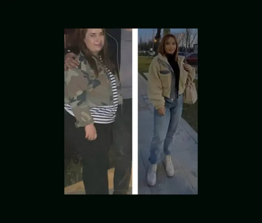 mustafa-atabey-md-gastric-sleeve-before-after-37