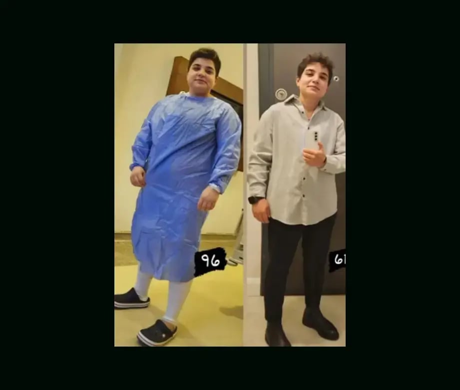 mustafa-atabey-md-gastric-sleeve-before-after-38