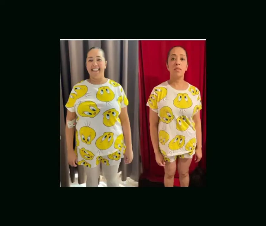 mustafa-atabey-md-gastric-sleeve-before-after-39