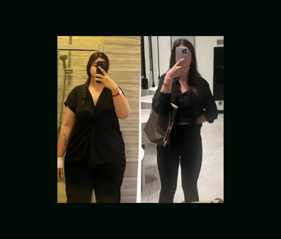 mustafa-atabey-md-gastric-sleeve-before-after-42