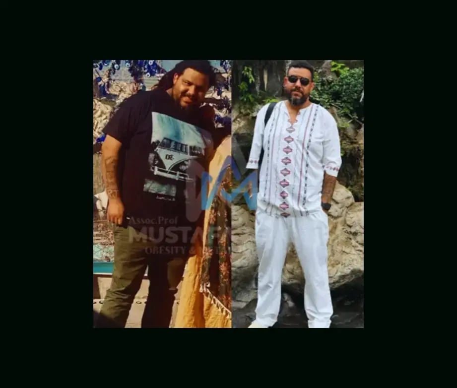 mustafa-atabey-md-gastric-sleeve-before-after-43