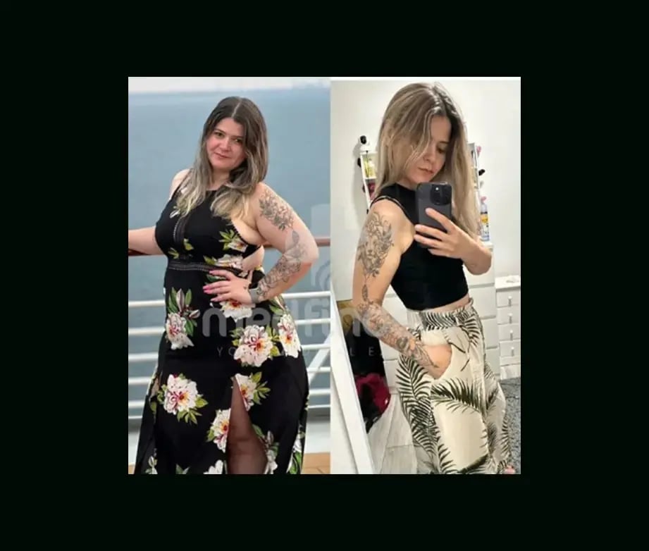 mustafa-atabey-md-gastric-sleeve-before-after-44
