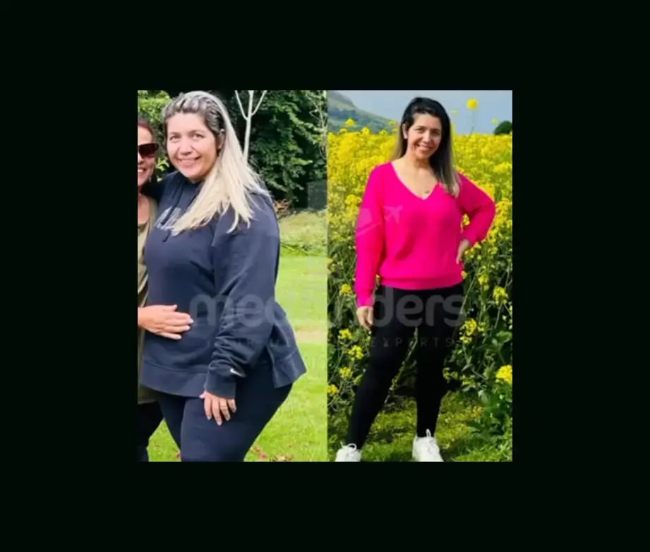 mustafa-atabey-md-gastric-sleeve-before-after-46