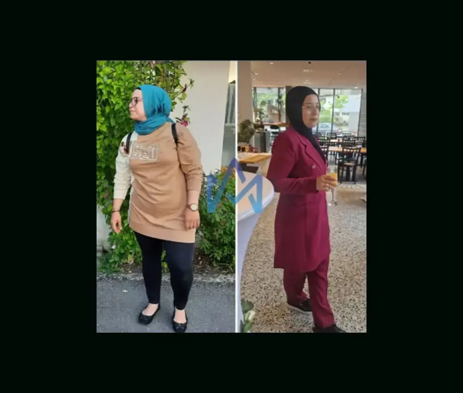 mustafa-atabey-md-gastric-sleeve-before-after-47