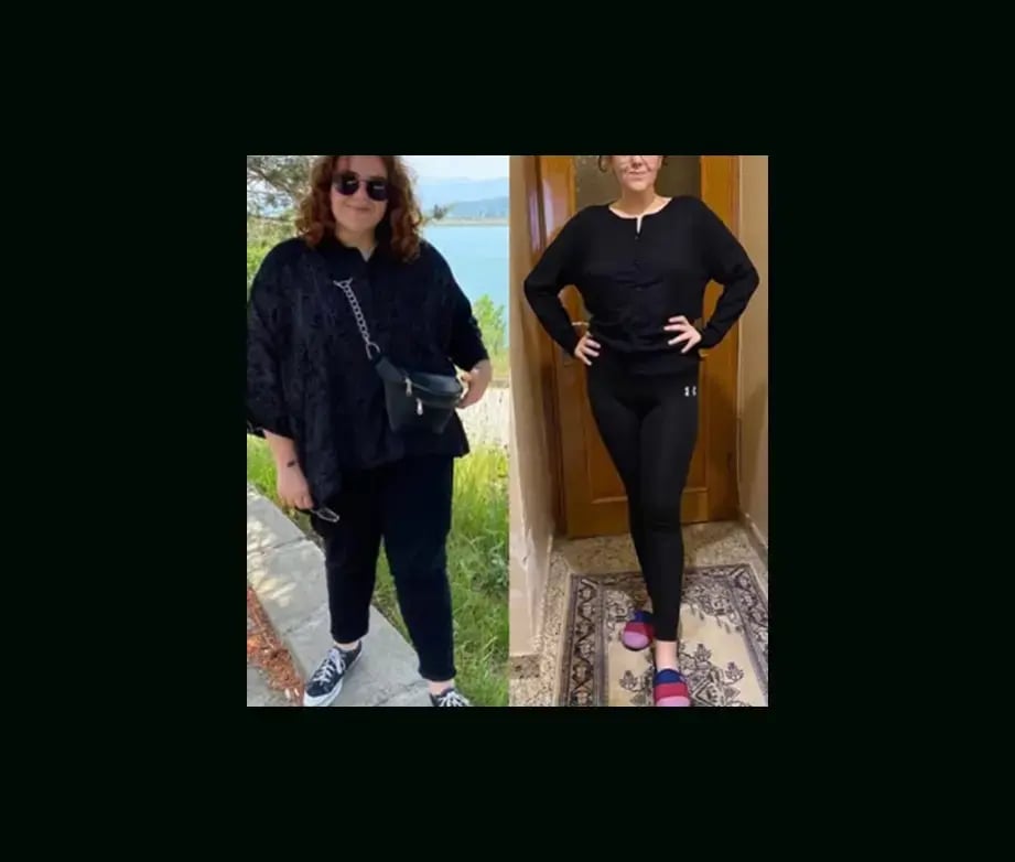 mustafa-atabey-md-gastric-sleeve-before-after-5