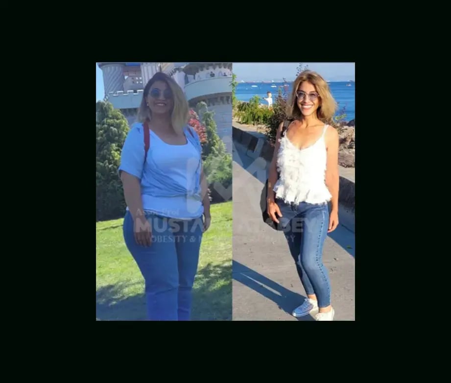 mustafa-atabey-md-gastric-sleeve-before-after-50