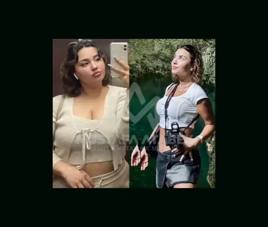 mustafa-atabey-md-gastric-sleeve-before-after-51