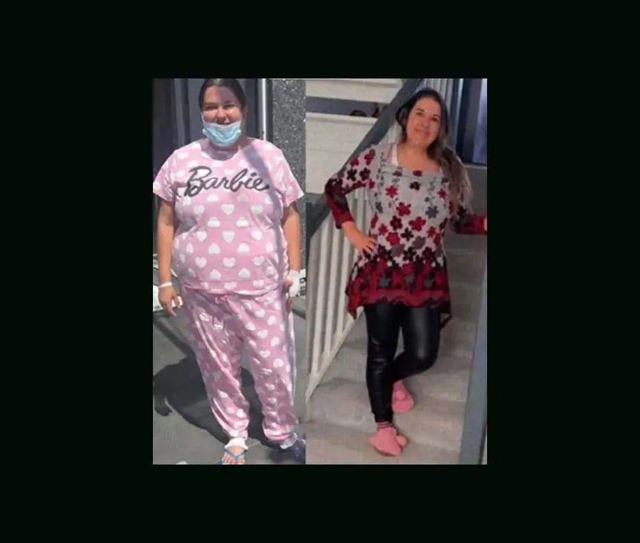 mustafa-atabey-md-gastric-sleeve-before-after-7