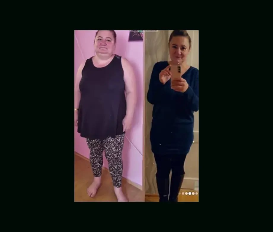 mustafa-atabey-md-gastric-sleeve-before-after-9