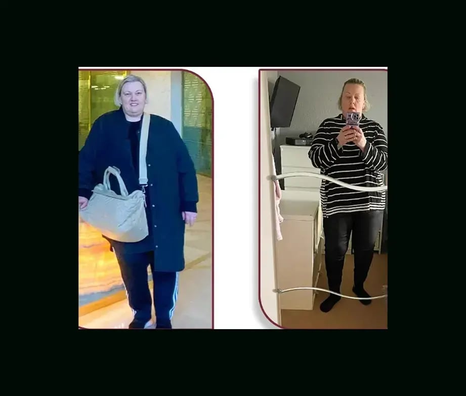 mustafa-uygar-alayci-md-gastric-sleeve-before-after-1-1