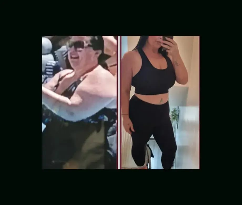 mustafa-uygar-alayci-md-gastric-sleeve-before-after-2-1