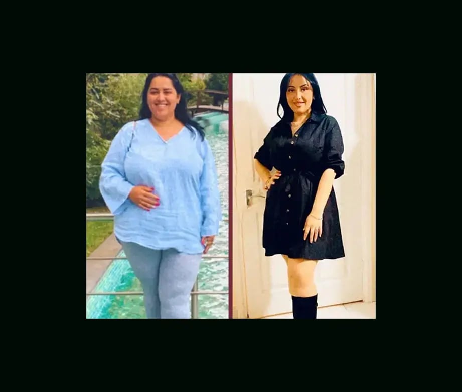mustafa-uygar-alayci-md-gastric-sleeve-before-after-3 (1)-1