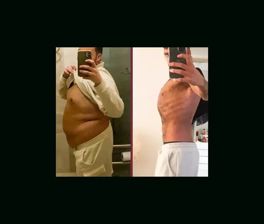 mustafa-uygar-alayci-md-gastric-sleeve-before-after-4-1