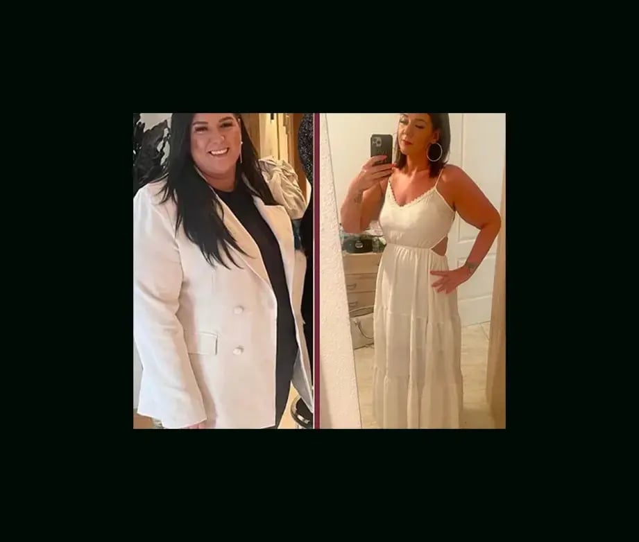 mustafa-uygar-alayci-md-gastric-sleeve-before-after-5-1