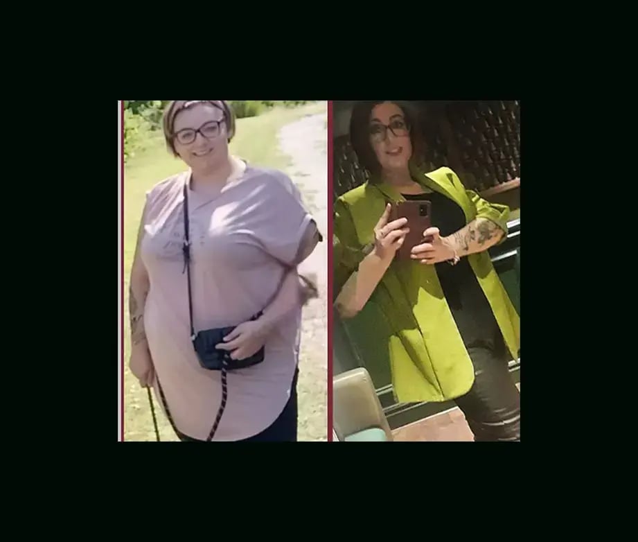 mustafa-uygar-alayci-md-gastric-sleeve-before-after-6-1