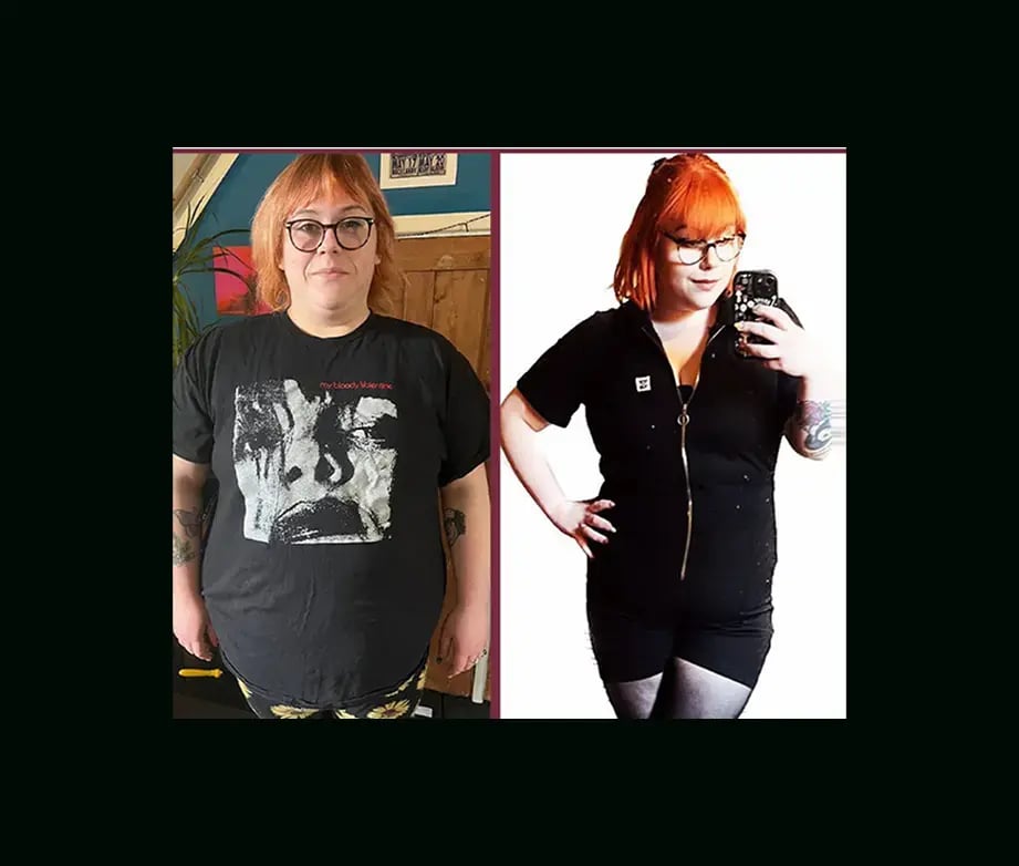mustafa-uygar-alayci-md-gastric-sleeve-before-after-7-1