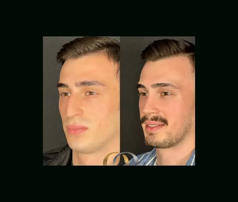 oguzhan-oguz-md-rhinoplasty-before-after-1-1