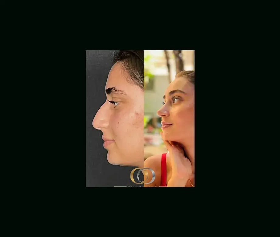 oguzhan-oguz-md-rhinoplasty-before-after-10