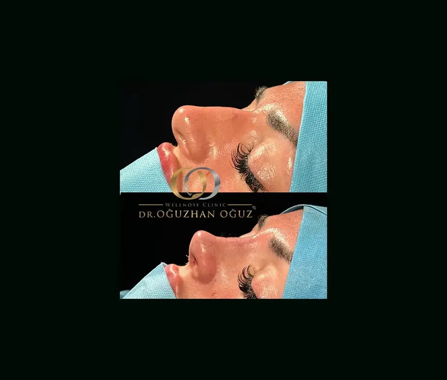oguzhan-oguz-md-rhinoplasty-before-after-11