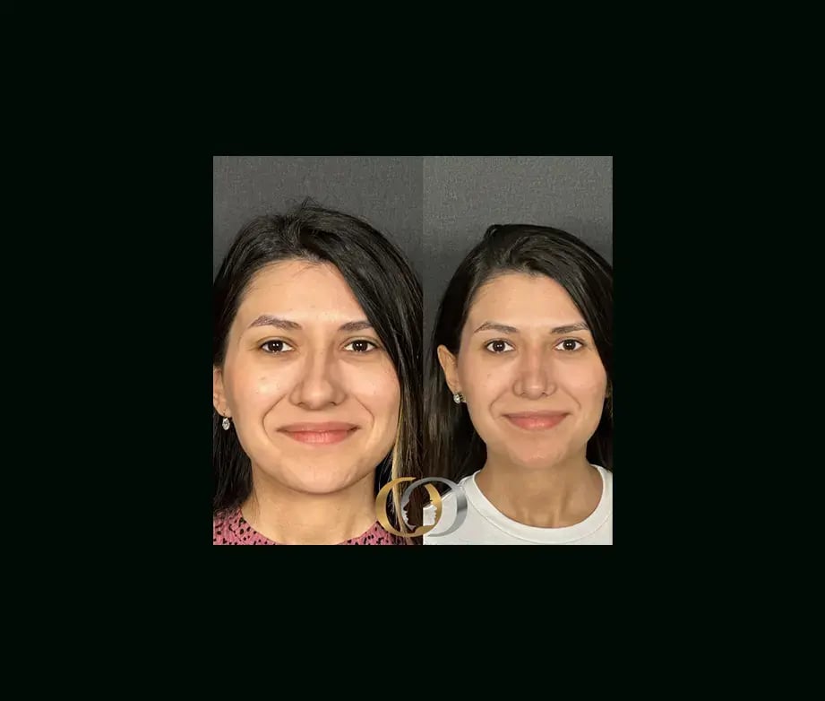 oguzhan-oguz-md-rhinoplasty-before-after-12