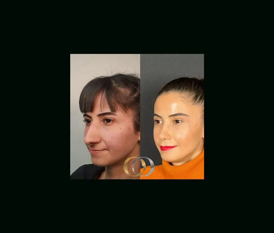 oguzhan-oguz-md-rhinoplasty-before-after-13