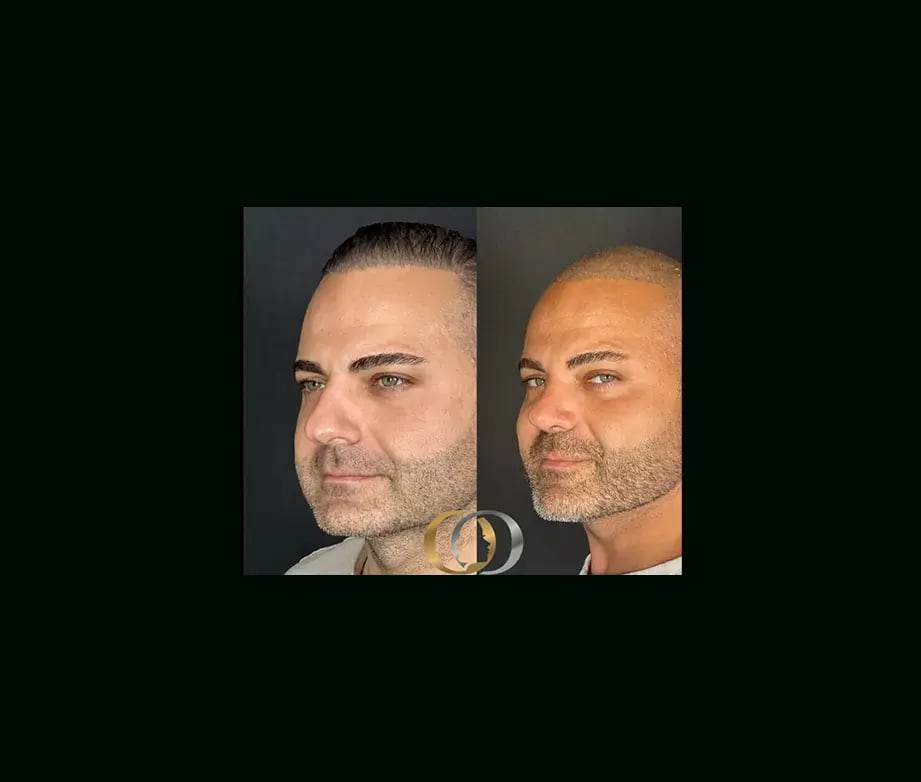 oguzhan-oguz-md-rhinoplasty-before-after-14