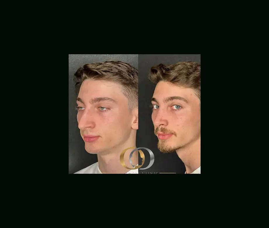 oguzhan-oguz-md-rhinoplasty-before-after-15