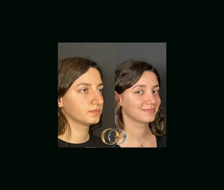oguzhan-oguz-md-rhinoplasty-before-after-16
