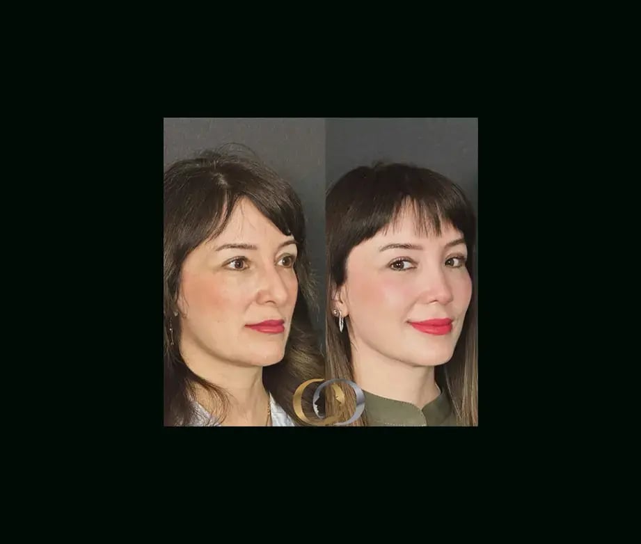oguzhan-oguz-md-rhinoplasty-before-after-17