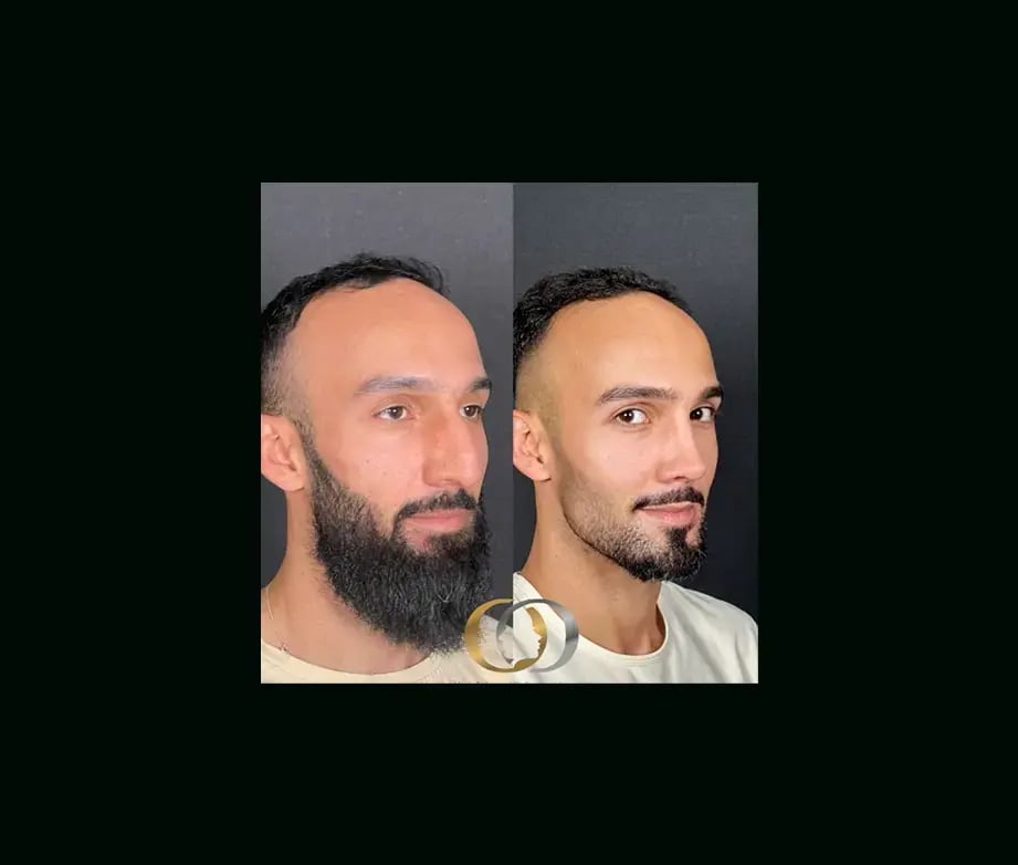 oguzhan-oguz-md-rhinoplasty-before-after-18