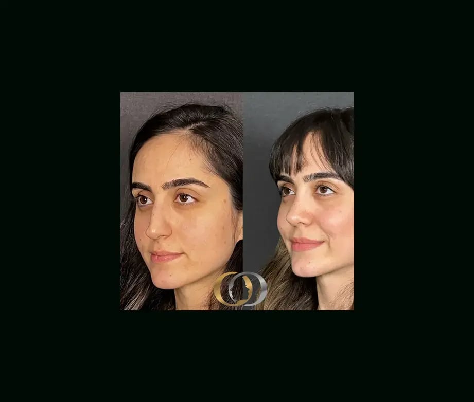 oguzhan-oguz-md-rhinoplasty-before-after-19