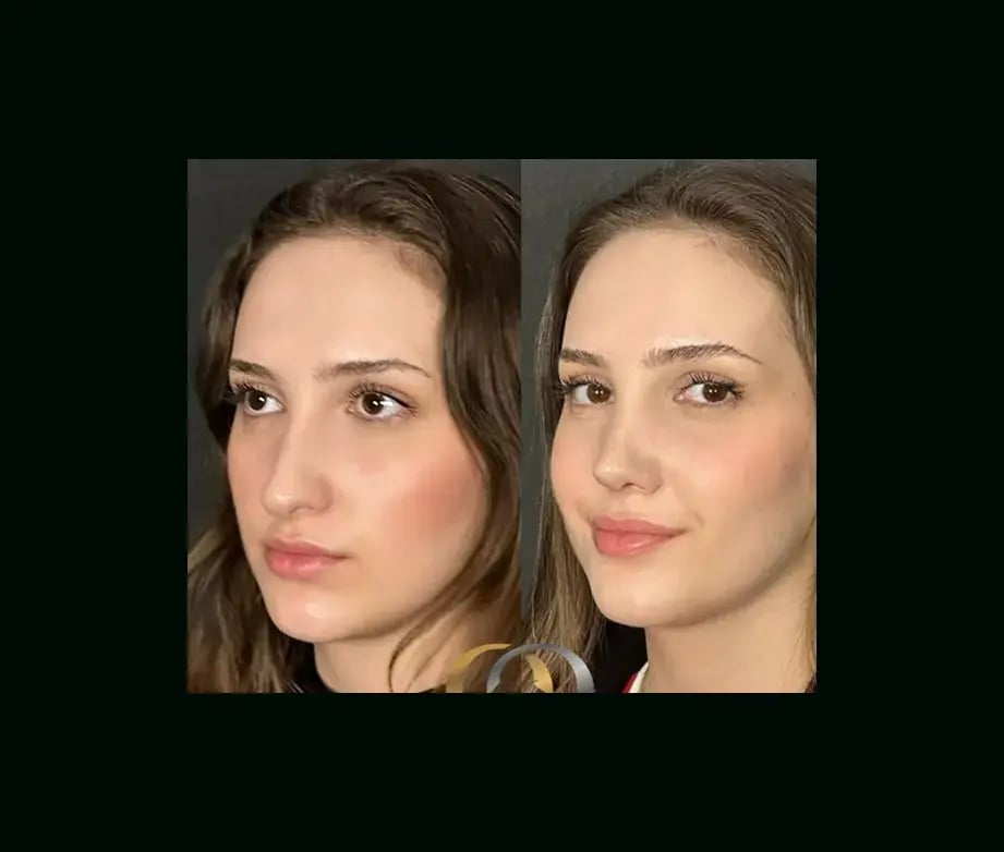 oguzhan-oguz-md-rhinoplasty-before-after-2-2